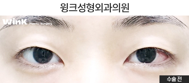 인라인 자연유착 쌍꺼풀 수술에 대해 알아볼까요? 관련 이미지 5