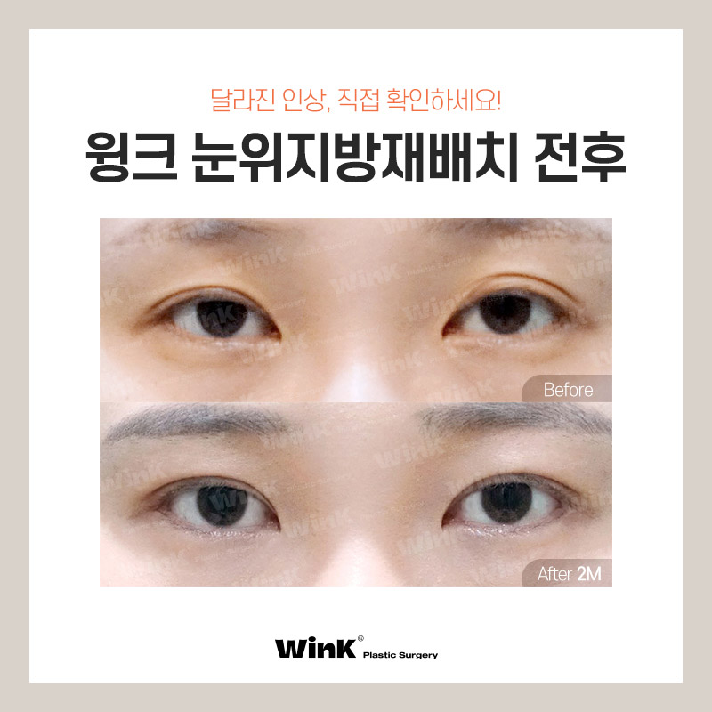 Lift Tired-Looking Eyelids with Upper Eyelid Fat Repositioning at Wink Plastic Surgery! image 6
