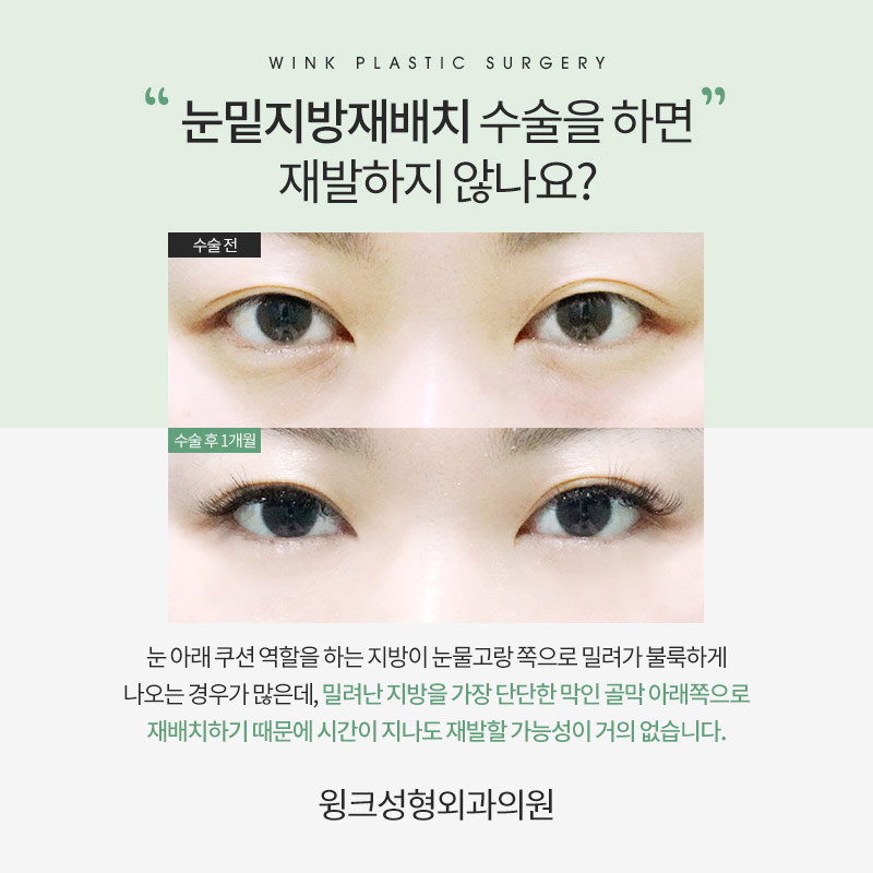다크서클이 고민이라면, 윙크성형외과 눈밑지방재배치로 깔끔하게! 관련 이미지 7