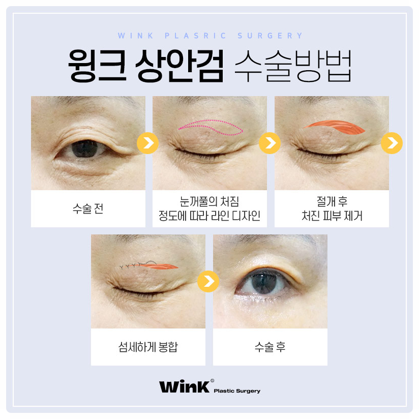 If You’re Looking Into Droopy Eyelid Surgery, Wink Plastic Surgery Upper Blepharoplasty and the Best Place for Upper Eyelid Surgery image 4
