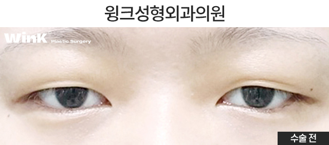 절개 쌍꺼풀 수술법에 관해 알아보겠습니다. 관련 이미지 5
