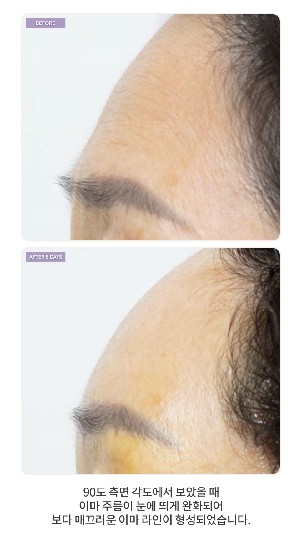 Forehead Lift (Forehead Lifting) — Why It Should Be Considered Along with Eye Surgery image 2