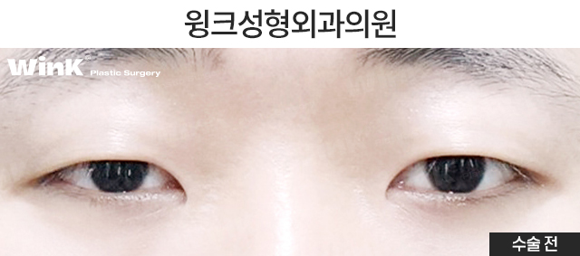 남자 자연유착 쌍꺼풀에 관해 알아볼까요? 관련 이미지 5