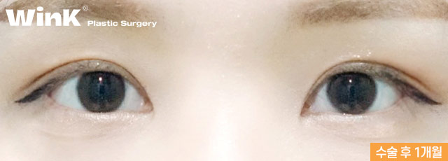 Wink’s Upper Blepharoplasty Revision Surgery, Considering Both Function and Aesthetics image 8