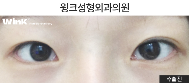 자연유착 재수술 시 주의점에 대해 알아보겠습니다. 관련 이미지 5