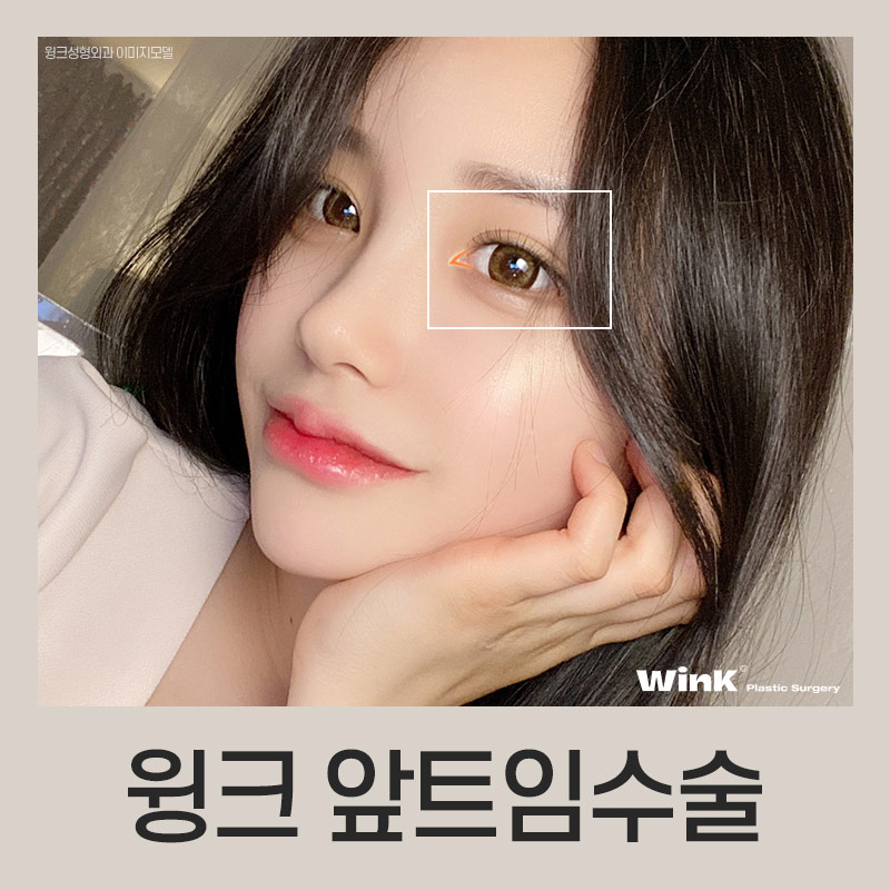 몽고주름이 쌍꺼풀 수술에 미치는 영향! 윙크성형외과에서 알려드려요 관련 이미지 7