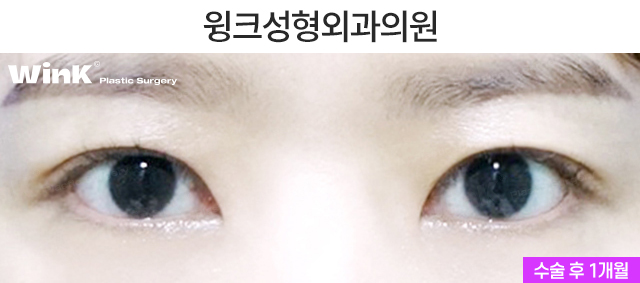 Shall We Take a Look at the Symptoms of Double Eyelid Loosening? image 3
