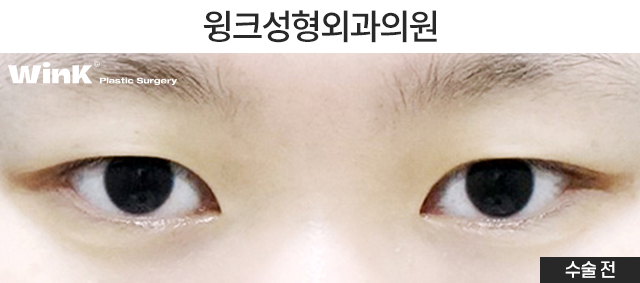 I Would Like to Talk About Natural Adhesion Double Eyelid Surgery. image 2