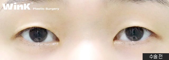 Wink Plastic Surgery’s Non-Incisional Ptosis Correction for Clearer Eyes Without an Incision! image 8