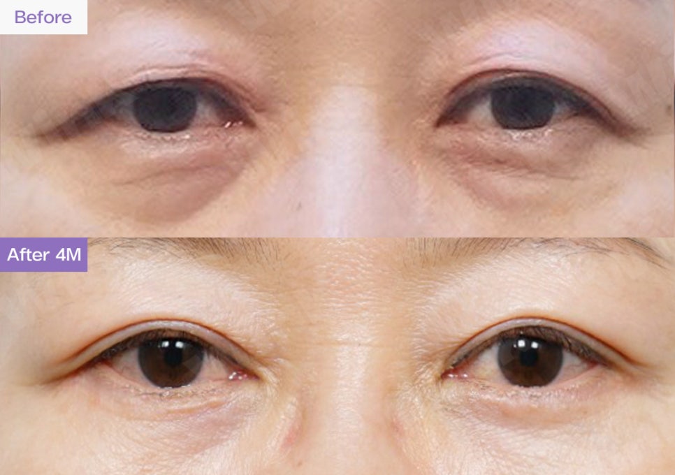 Upper Blepharoplasty or Sub-Brow Lift? Which Procedure Is Suitable for Middle-Aged Eye Plastic Surgery? image 2