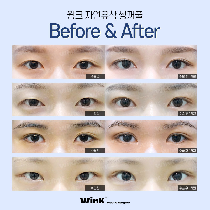 Wink Plastic Surgery’s Natural Adhesion Technique for Naturally Beautiful Eyes That Look Like They’ve Always Been There! image 7