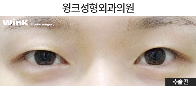 Let’s Take a Look at Double Eyelid Surgery for Droopy Eyes. image 5