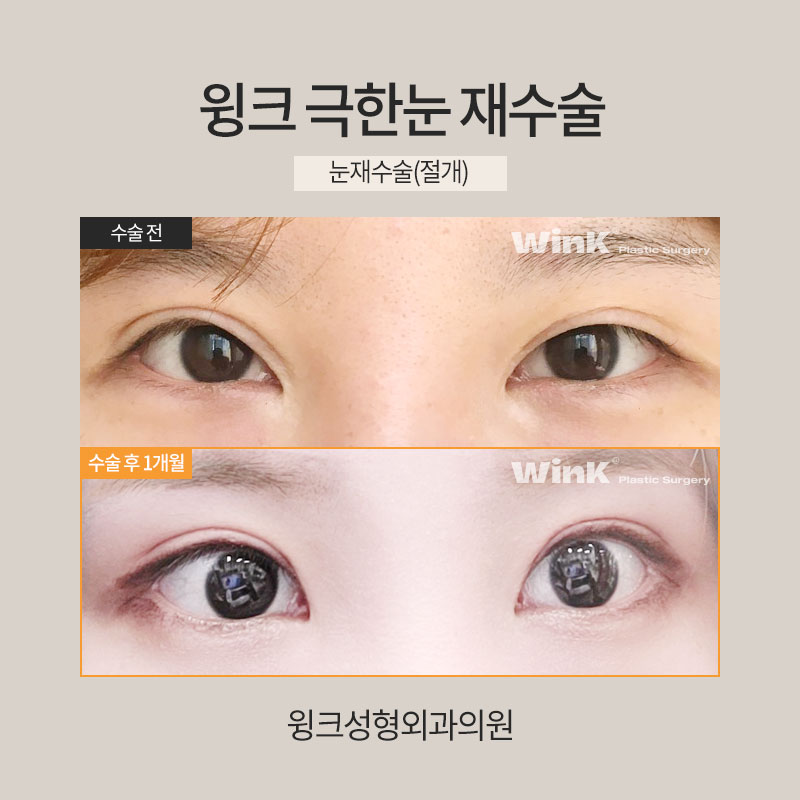 Let’s Learn About Revision Surgery for Severe Eyes? image 3