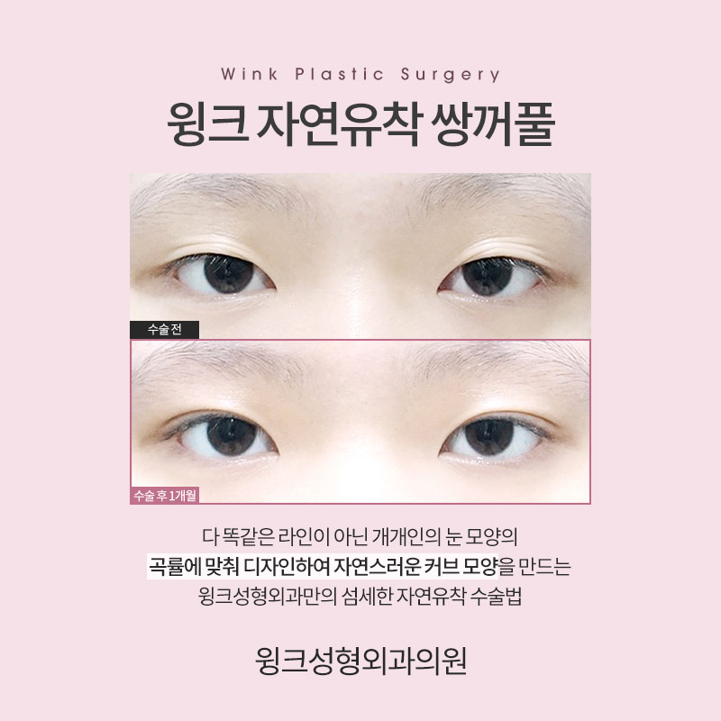 자연유착 쌍꺼풀 수술에 대해 알아보겠습니다. 관련 이미지 2