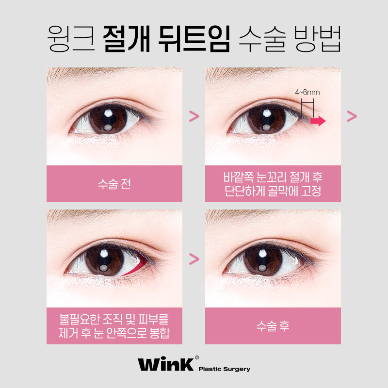 신사트임잘하는곳?  윙크성형외과 절개뒤밑트임후기! 관련 이미지 4