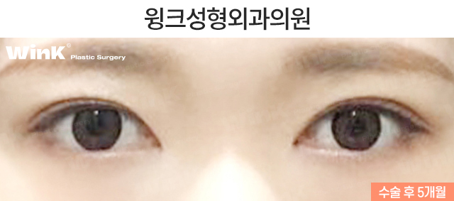 두줄따기 절개 눈재수술로 소세지눈에서 벗어나 볼까요? 관련 이미지 6