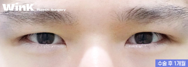 Monolid, inner double eyelid, or outer double eyelid? Choose the line that suits you! Men’s eye surgery at Wink Plastic Surgery image 5