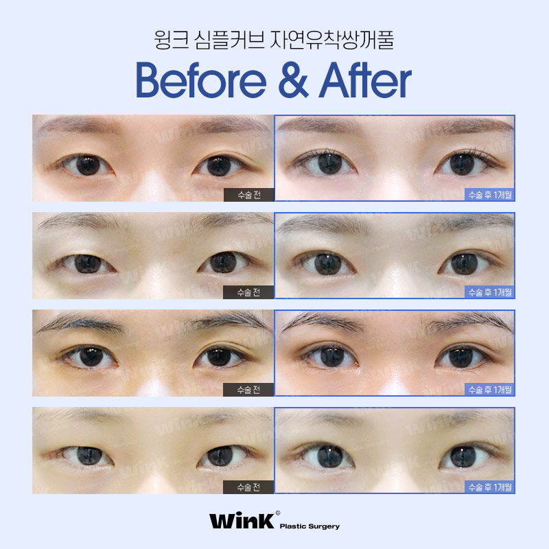 윙크성형외과 심플커브 자연유착 자연유착쌍꺼풀후기 자연스러운쌍수 쌍수자연유착 관련 이미지 7