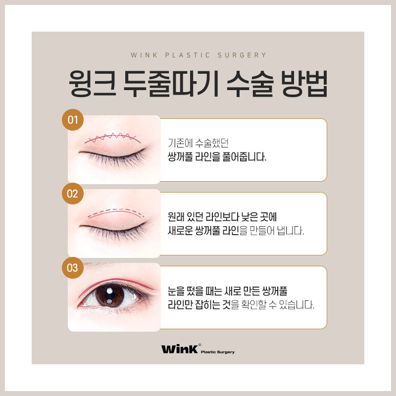 두줄따기 쌍꺼풀 라인낮추기로 부담스러운 눈매는 그만! 관련 이미지 10