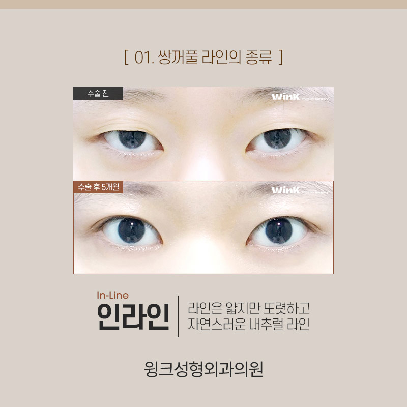 인아웃연예인은 누가 있을까? 윙크성형외과와 알아보는 쌍꺼풀 라인 종류! 관련 이미지 4