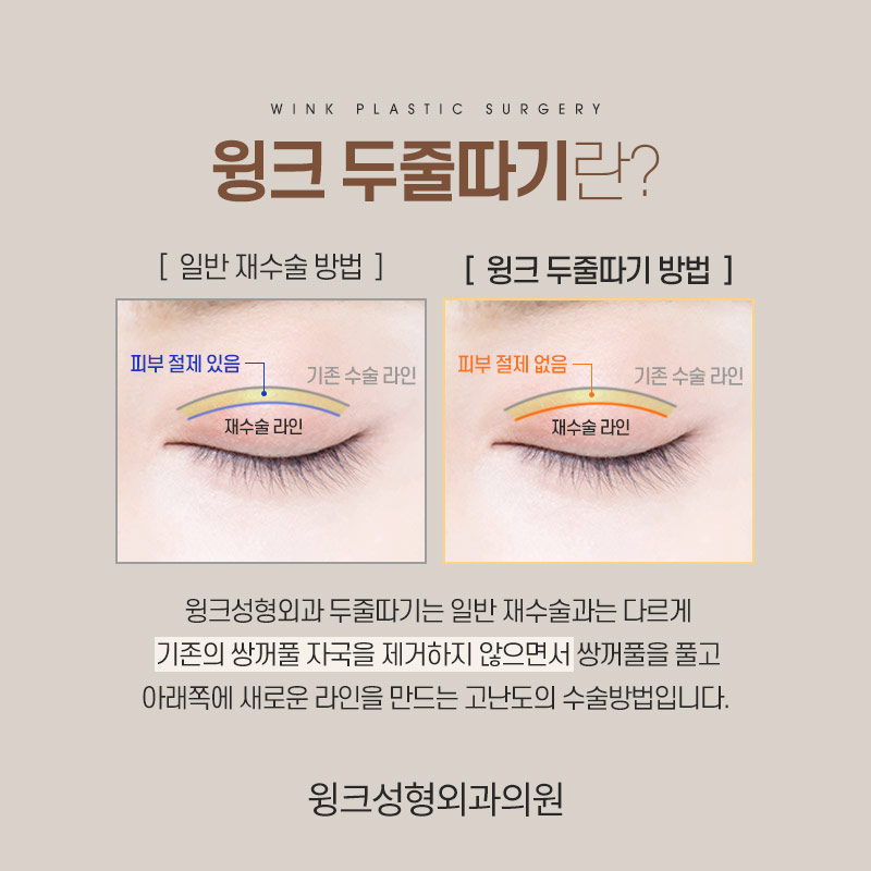 두줄따기로 라인 낮추기 하고 나서 흉터는 어떨까? 관련 이미지 2