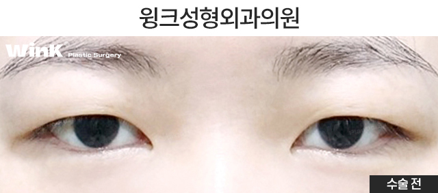 Let’s Learn About Incisional Double Eyelid Surgery. image 2