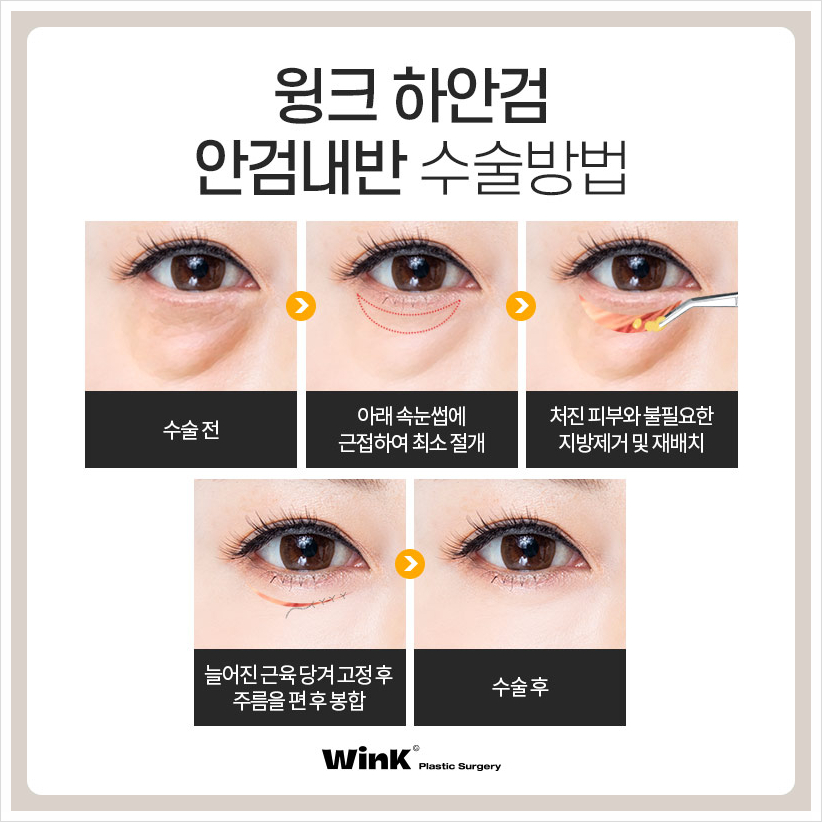 Lower Eyelid Entropion, Eyelashes Poking the Eye, Wink Plastic Surgery, Before and After Entropion Surgery image 5