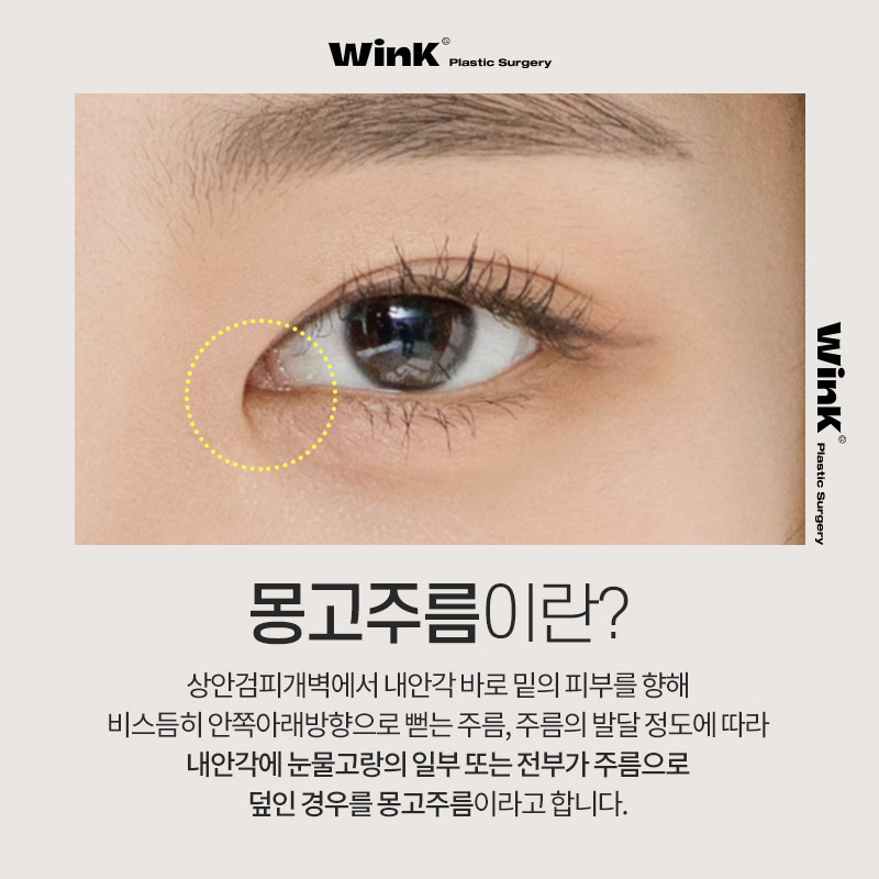 몽고주름이 쌍꺼풀 수술에 미치는 영향! 윙크성형외과에서 알려드려요 관련 이미지 2