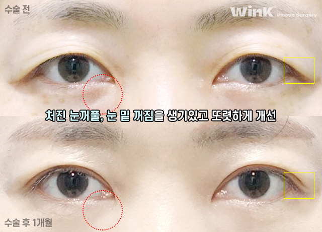 Improve Droopy Eyes with Wink Middle-Age Eyelid Surgery! image 9