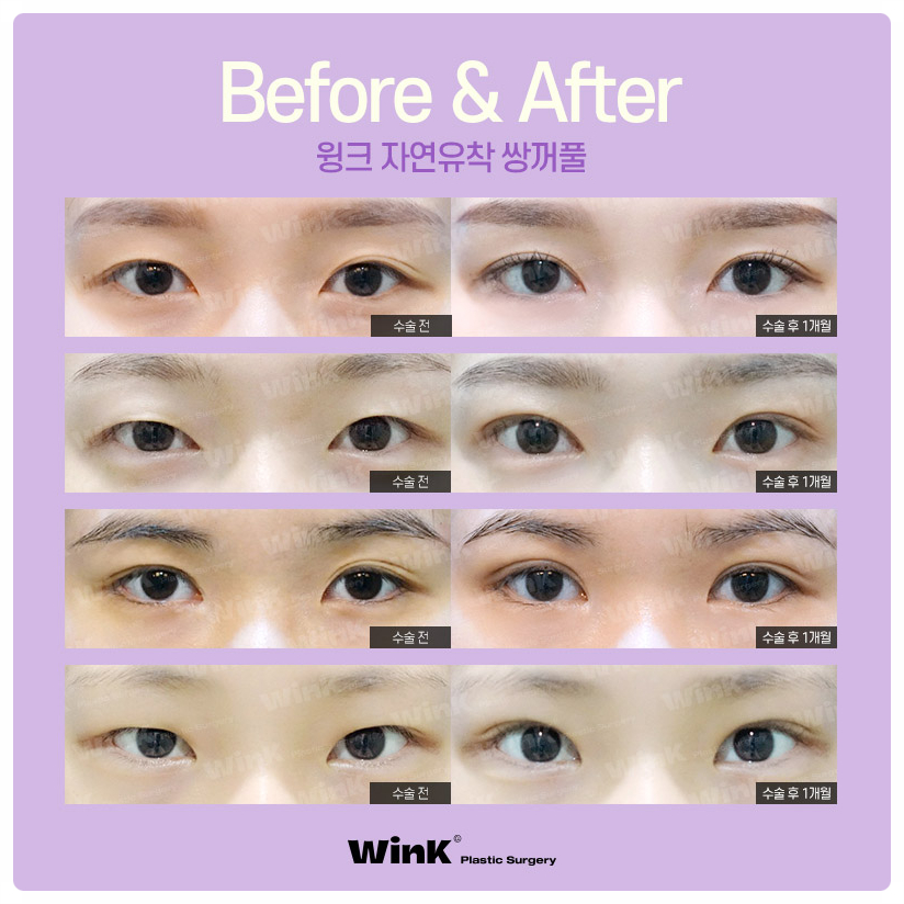 자연유착쌍꺼풀후기 자연유착법 윙크성형외과 자연유착쌍꺼풀비용 관련 이미지 7