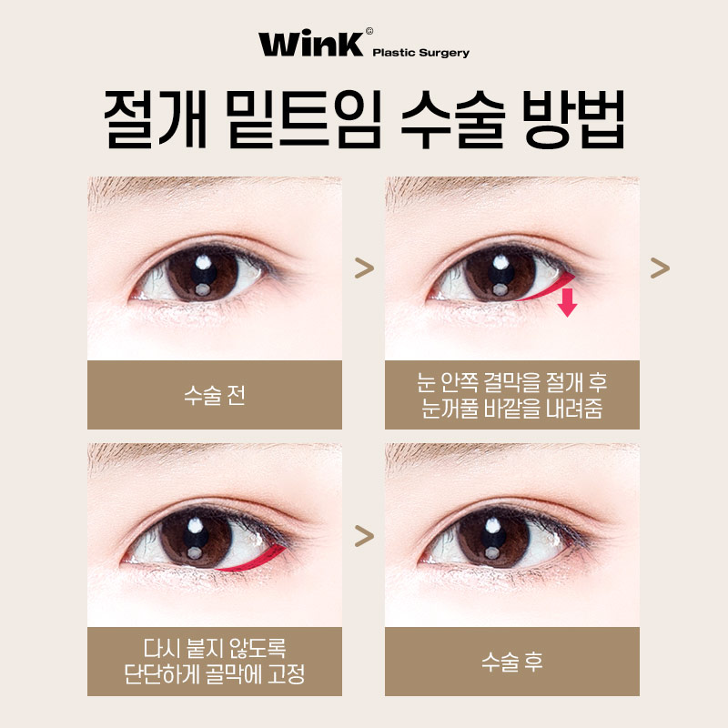 Elegant and Bright Eyes with Incisional Outer and Lower Canthoplasty at Wink Plastic Surgery! image 5