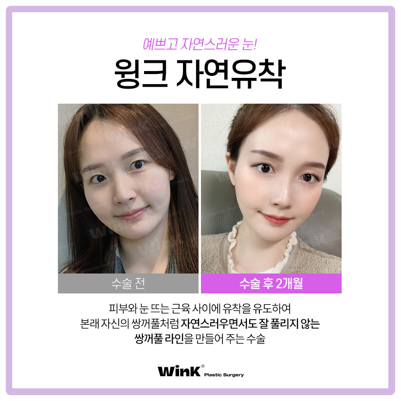자연유착쌍꺼풀후기 자연유착법 윙크성형외과 자연유착쌍꺼풀비용 관련 이미지 4