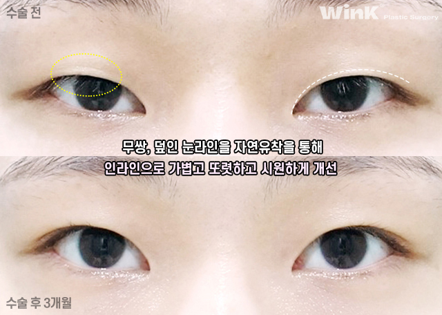Let’s Learn About Before and After Natural Adhesion Double Eyelid Surgery image 7