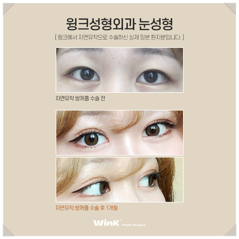 Japanese Double Eyelid Line? In-line Celebrity, Out-line Celebrity, and Wink Sinsa Natural Adhesion Double Eyelid Surgery image 7