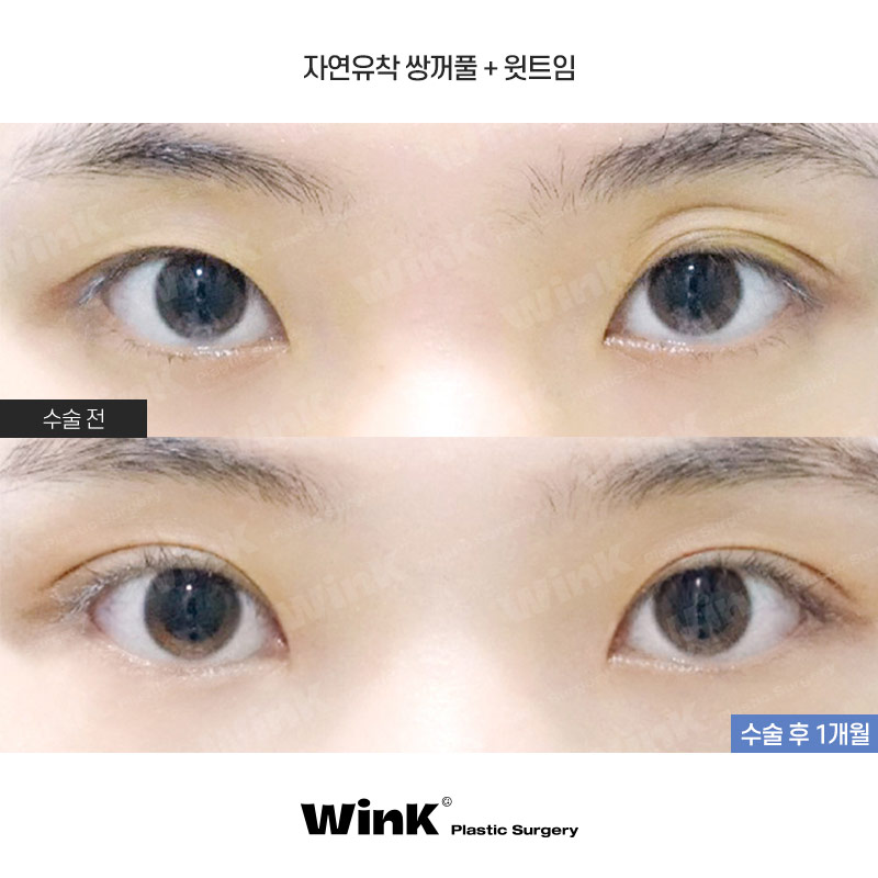 다 같은 라인? 윙크성형외과 심플커브 자연유착은 나에게 꼭 맞는 라인으로! 관련 이미지 1
