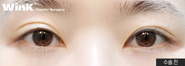 높은 쌍꺼풀 라인, 겹쌍꺼풀과 같은 유형의 눈재수술 방법은? 관련 이미지 3