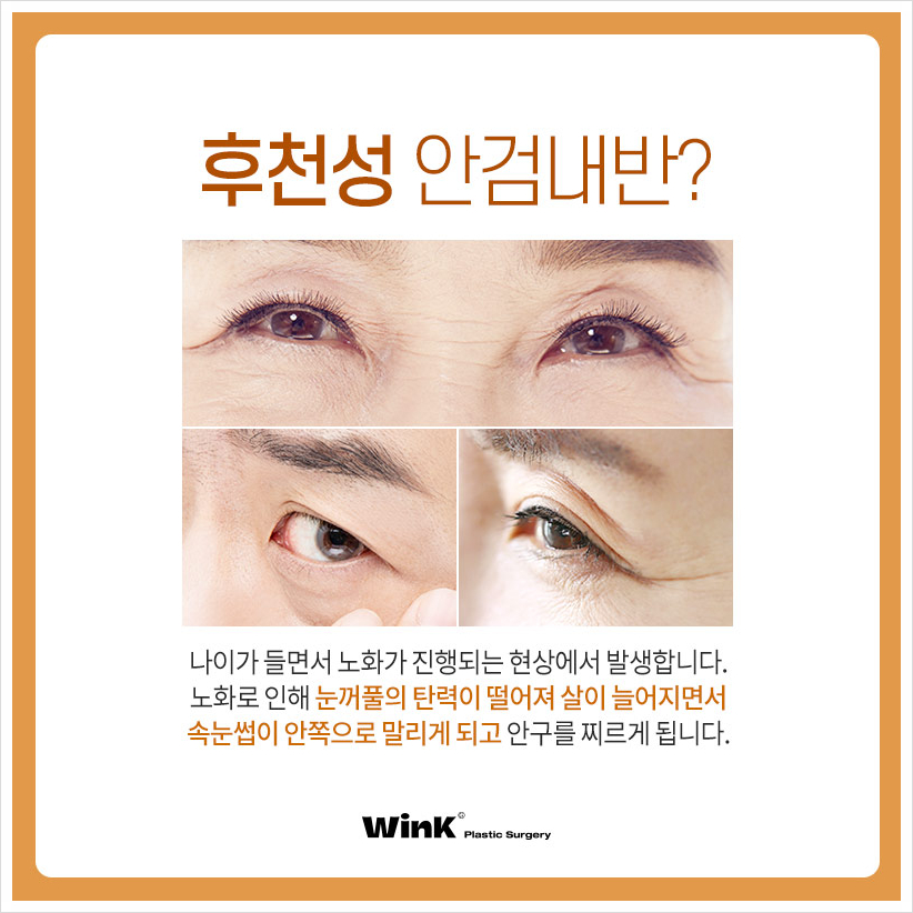상안검안검내반 속눈썹찔림수술  윙크성형외과 안검내반수술후기 관련 이미지 3