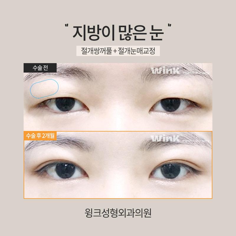 How Is Double Eyelid Surgery Performed on Eyes with a Lot of Fat? image 3