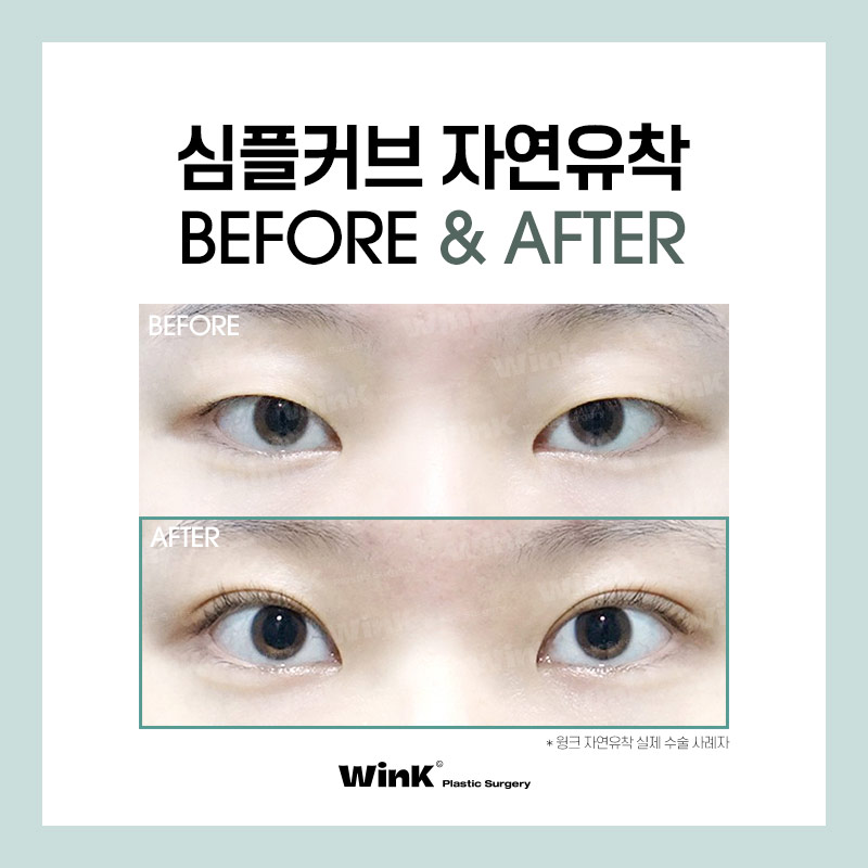 윙크성형외과만의 심플커브 자연유착으로 자연스럽고 매끈한 곡선 라인! 관련 이미지 7