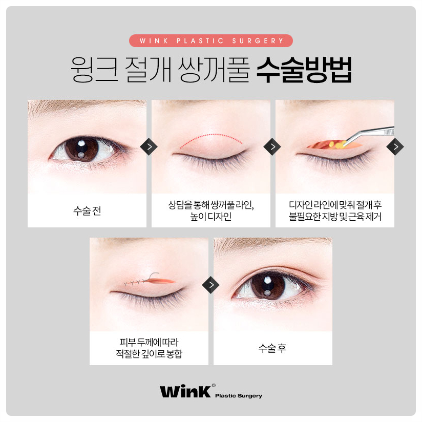 쌍꺼풀수술잘하는곳 쌍꺼풀만들기  신사쌍꺼풀수술 은 윙크성형외과 관련 이미지 3