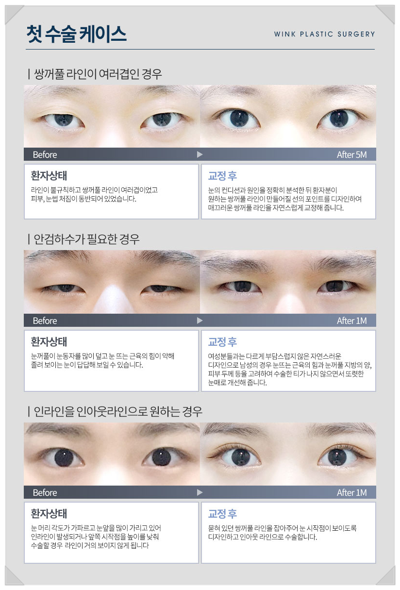 눈성형잘하는곳 신사눈재수술유명한곳 윙크성형외과 최승협원장님 눈성형명의 관련 이미지 8