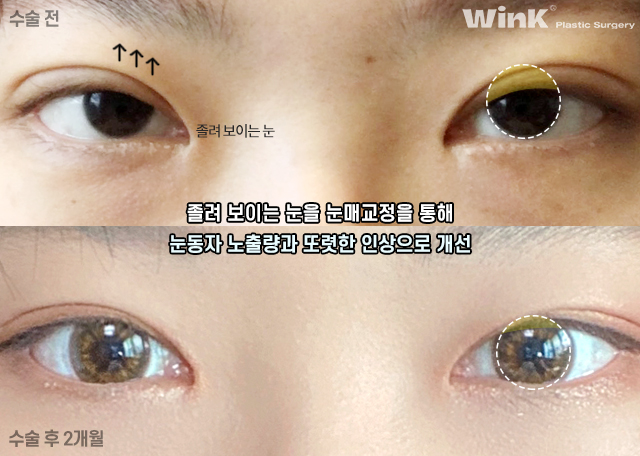 눈매교정의 효과에 대해 알아보겠습니다. 관련 이미지 4