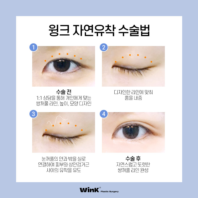 다 같은 라인? 윙크성형외과 심플커브 자연유착은 나에게 꼭 맞는 라인으로! 관련 이미지 2