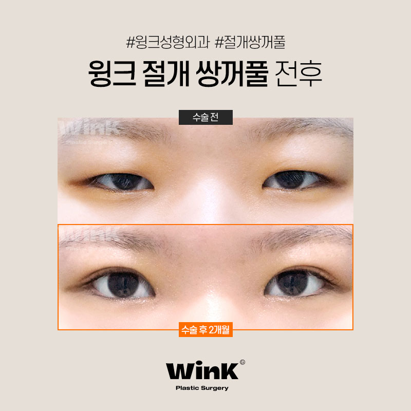 Wink Plastic Surgery Incisional Double Eyelid Surgery Offers Fast Recovery with Minimal Bruising and Swelling! image 8