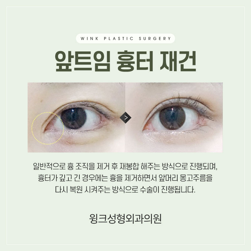 앞트임 흉 재건에 대해 알아보겠습니다. 관련 이미지 2