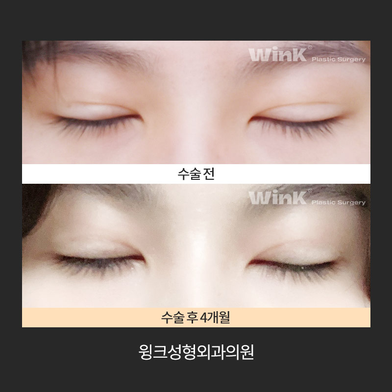 How Do You Release Deep Double Eyelid Fixation? image 8