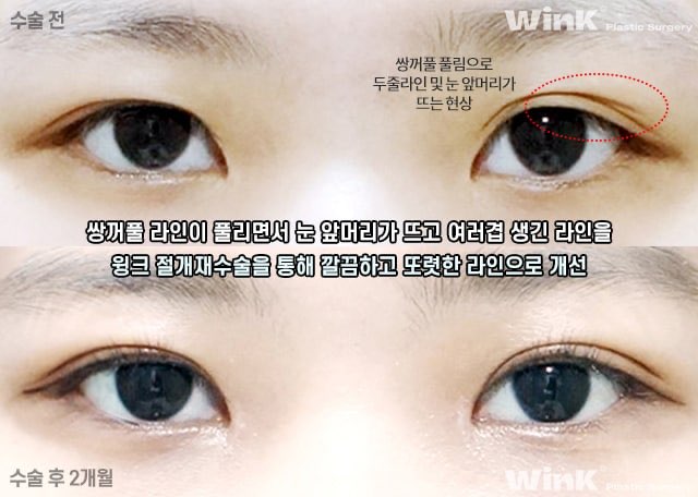 겹쌍꺼풀 해결 방법에 대해 알아보겠습니다. 관련 이미지 7