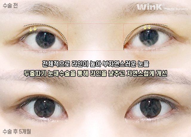 두줄따기 눈재수술로 수술 직후에도 자연스럽게! 관련 이미지 8