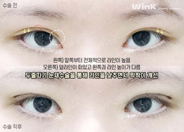 두줄따기 눈재수술로 수술 직후에도 자연스럽게! 관련 이미지 9