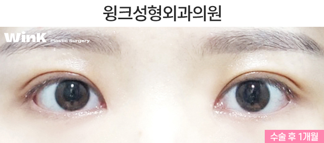 Shall We Learn About Revision Double Eyelid Surgery? image 6